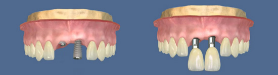 implant diş