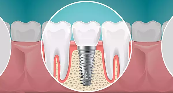 implant dis